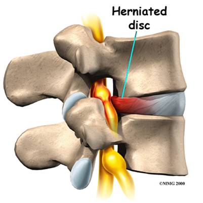 Herniation